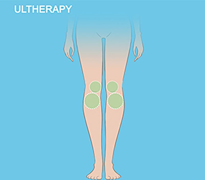 Knees - Ultherapy Grand Rapids