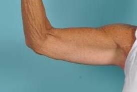 Arm Lift Before & After Image Patient 20001