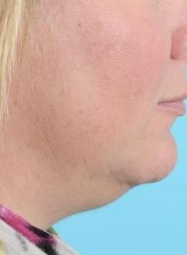 CoolSculpting Before & After Image Patient 23000