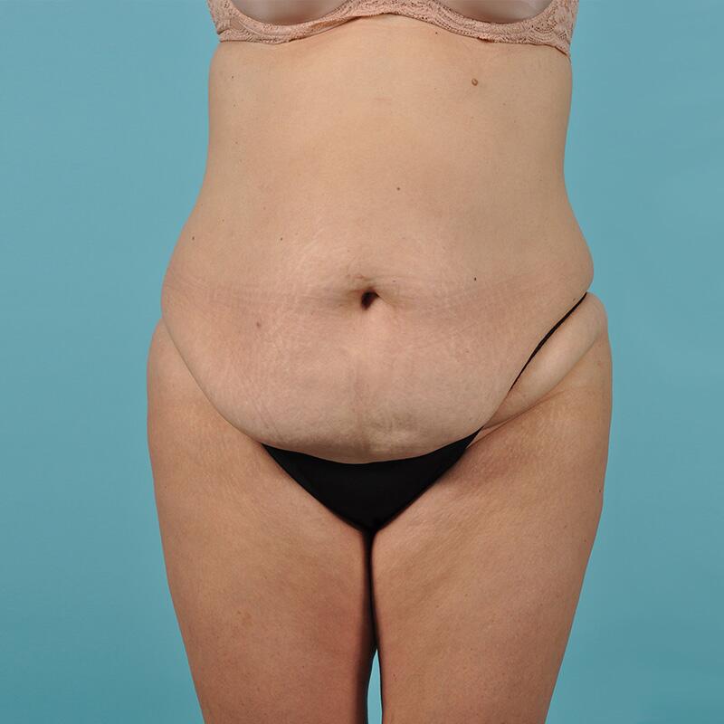 Fat Transfer Before & After Image Patient 23502