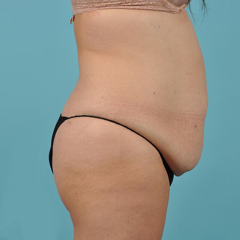 Fat Transfer Before & After Image Patient 23502