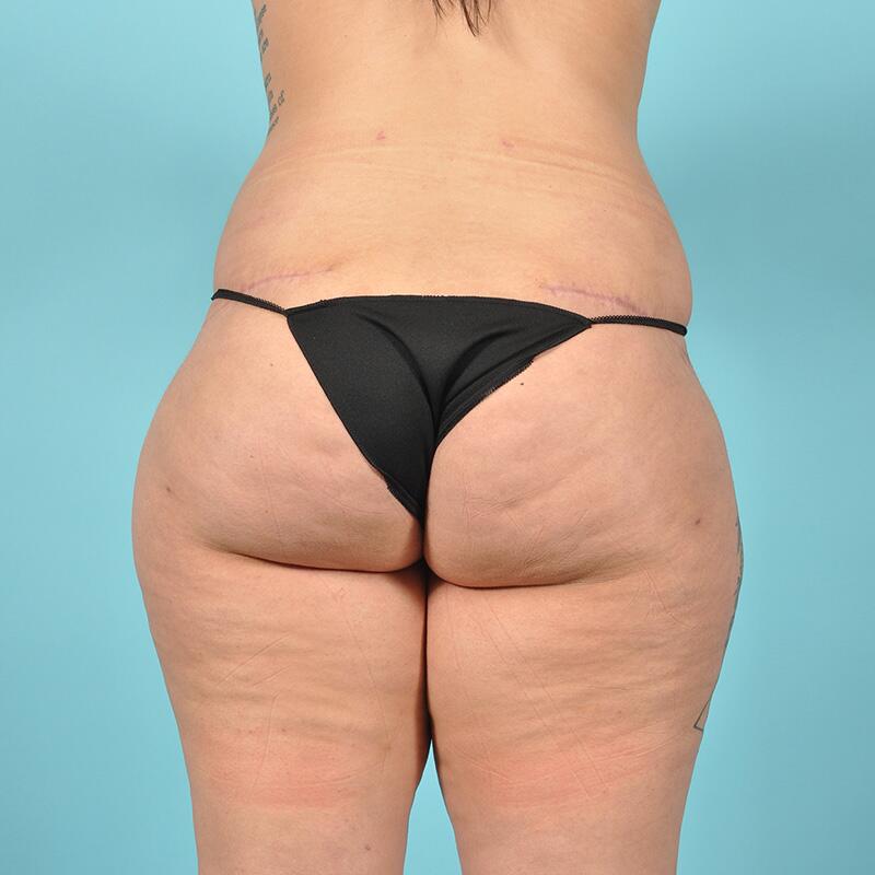 Liposuction Before & After Image Patient 27425