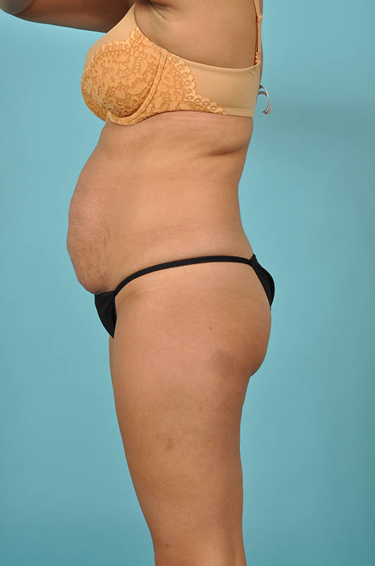 Liposuction Before & After Image Patient 27433