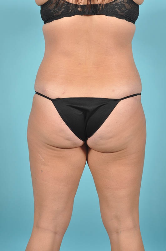 Liposuction Before & After Image Patient 29765