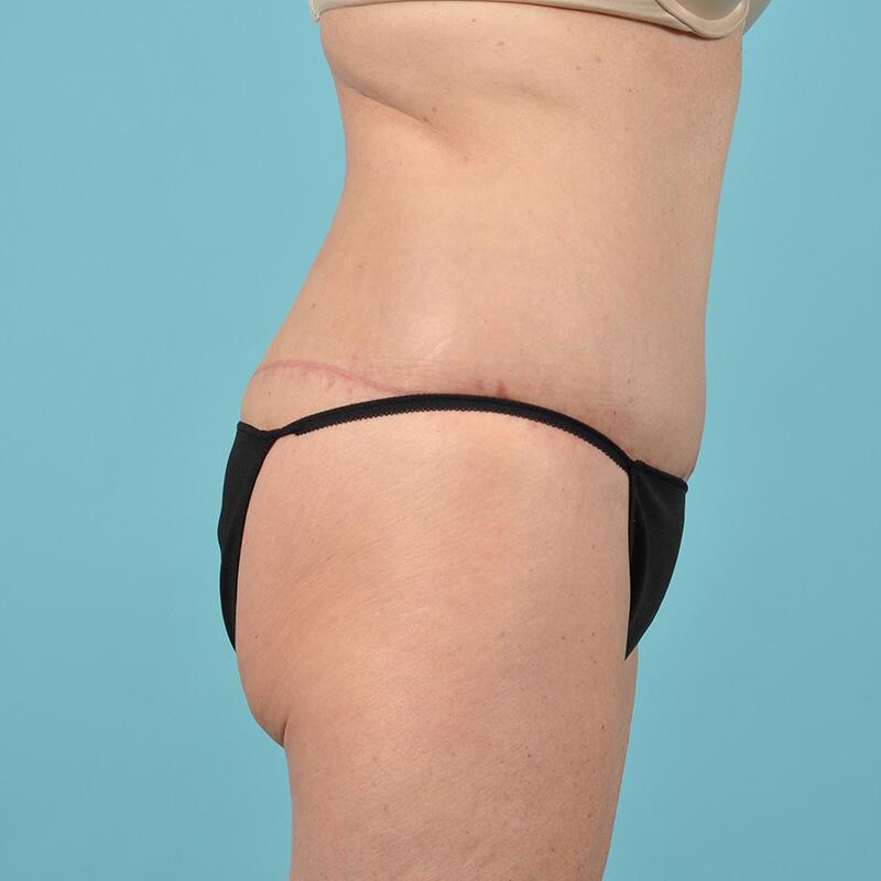 Tummy Tuck Before & After Image Patient 26629