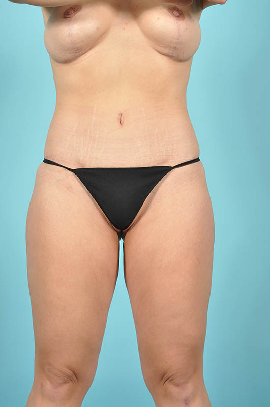 Tummy Tuck Before & After Image Patient 26649