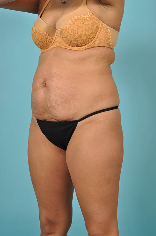 Tummy Tuck Before & After Image Patient 27433