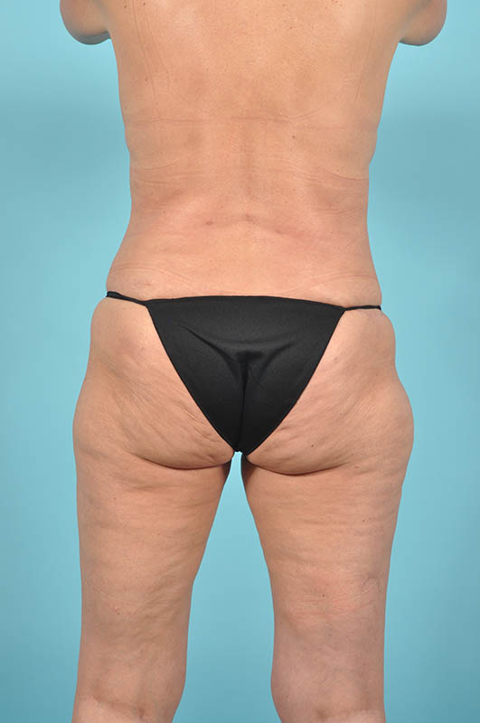 Tummy Tuck Before & After Image Patient 28938