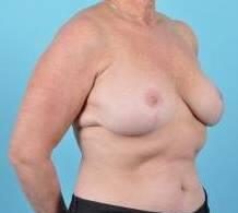 Breast Reduction For Women Before & After Image