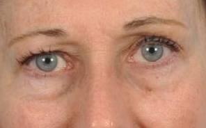Eyelid Surgery Before & After Image Patient 31004