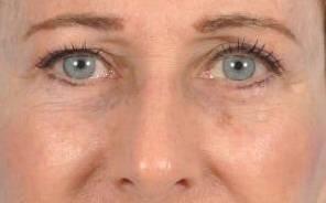 Eyelid Surgery Before & After Image Patient 31004