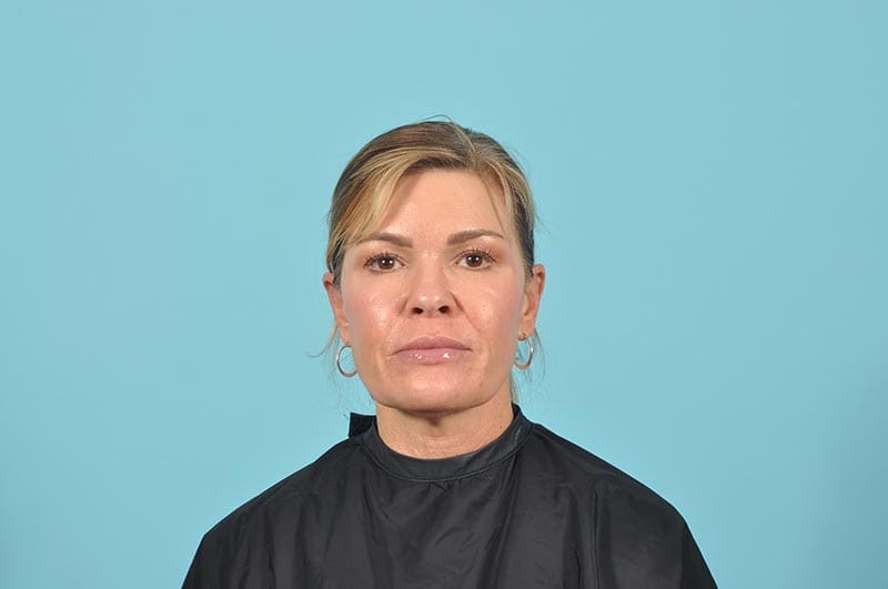 Facelift Before & After Image Patient 22292