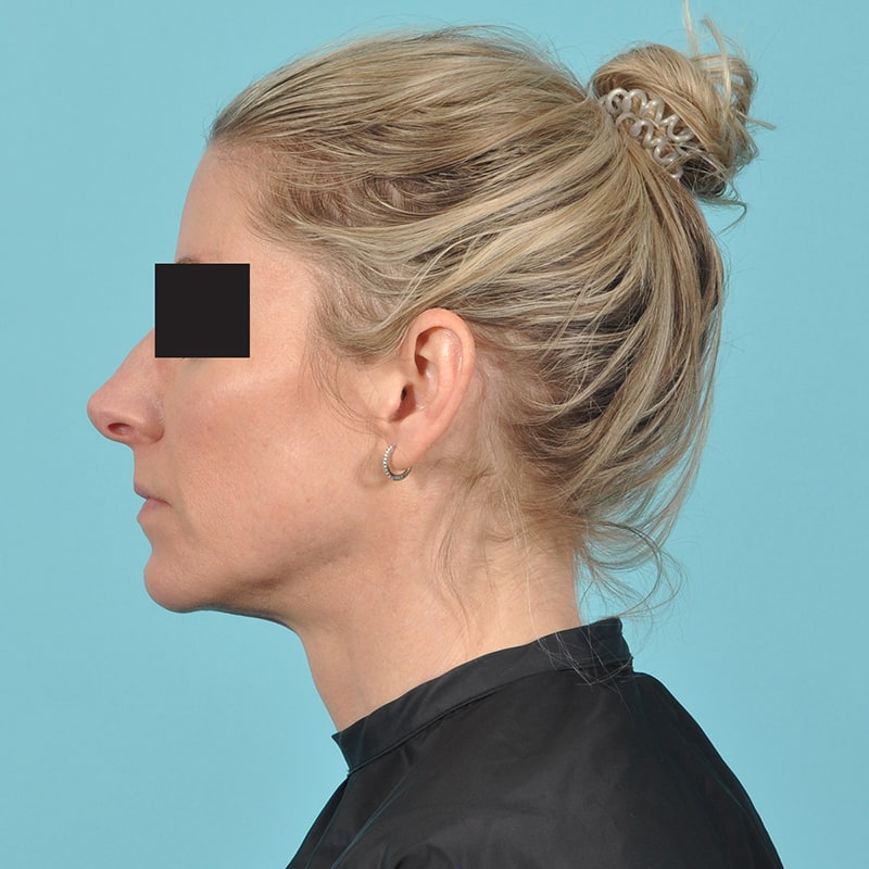 Rhinoplasty Before & After Image Patient 33301