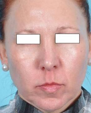 BOTOX Cosmetic Before & After Image