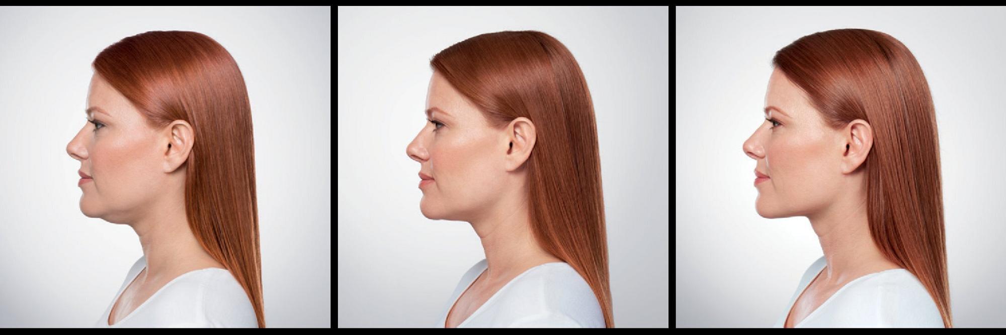 Kybella Before & After