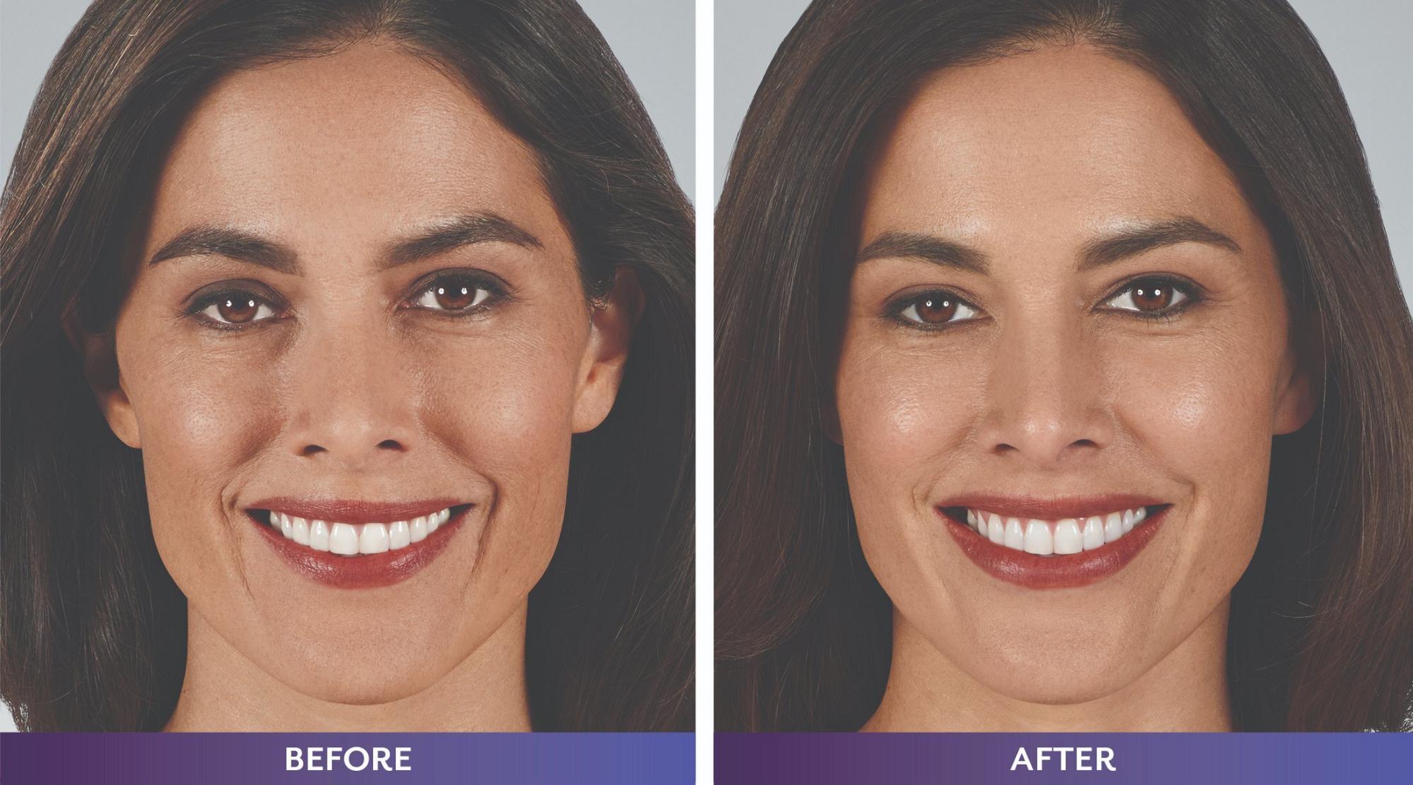 Grand Rapids liquid facelift model, before and after