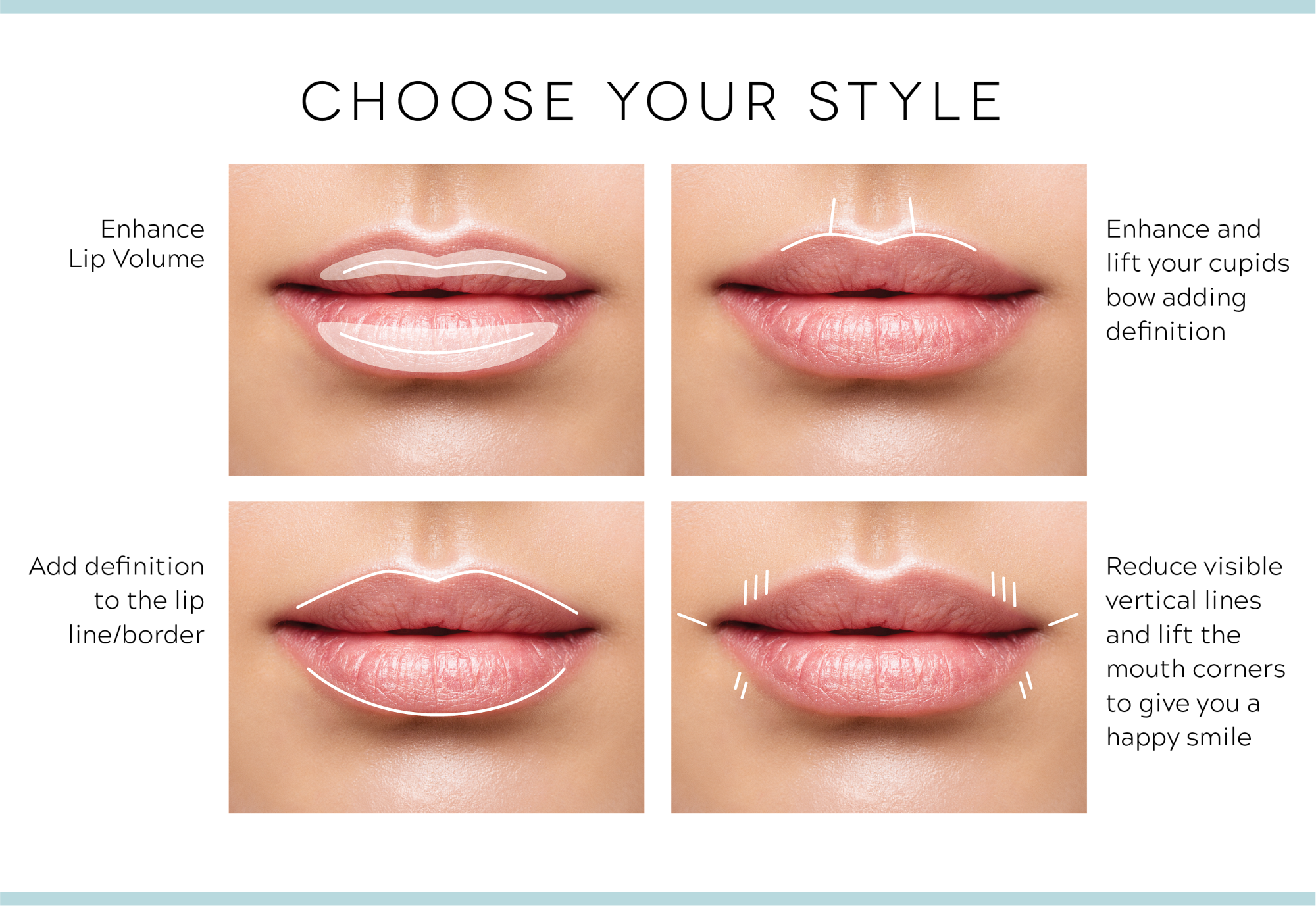 Choose Your Style - Enhance Lip Volume, Engance and lift your cupids bow adding definition, add definition to the lip line / border, Reduce visible verticle lines and lift the mouth corners to give you a happy smile.