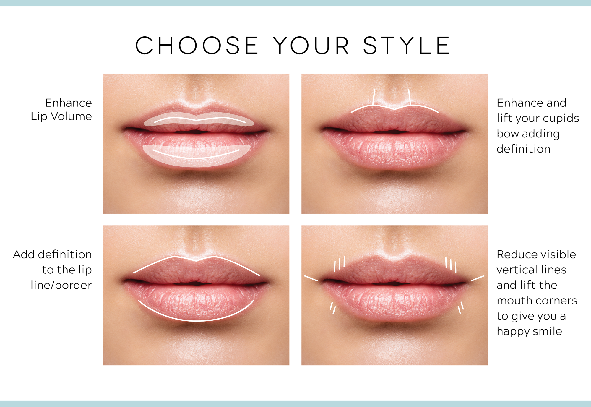 Lip Fillers Los Angeles