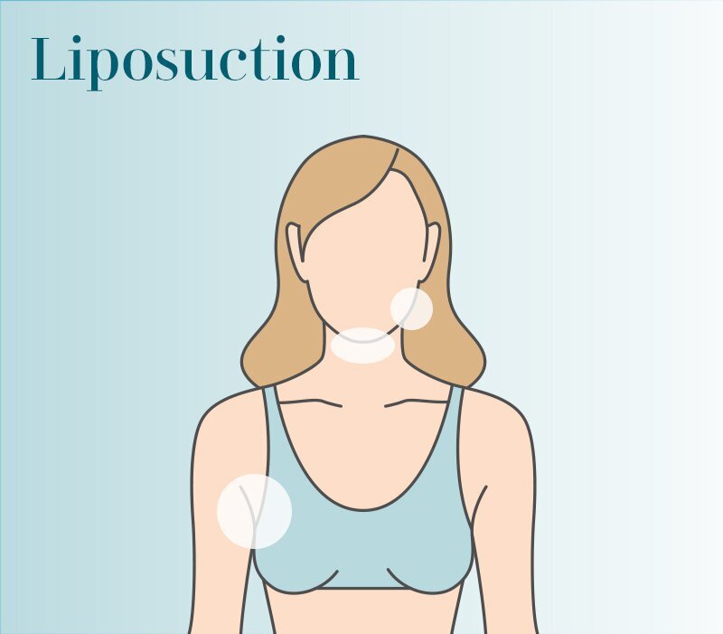 Grand Rapids Liposuction - Submental, Upper Breasts, Upper Arms diagram
