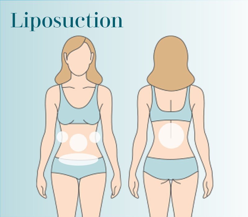 Abdomen, Flanks, Hips, Back Liposuction Grand Rapids diagram