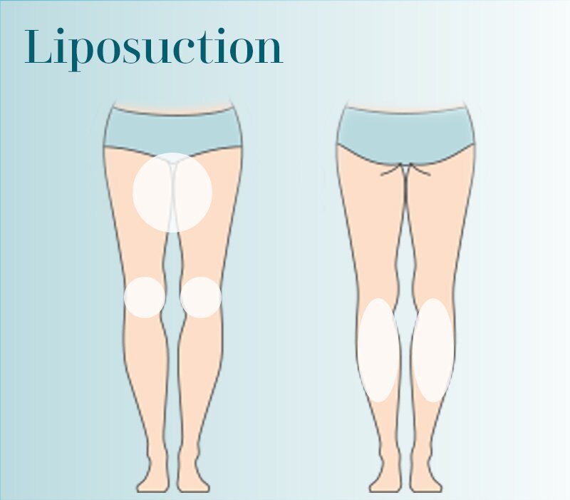 Grand Rapids Liposuction - Thighs, Knees, Calves diagram