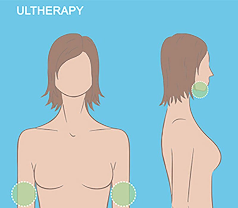 Submental Area, Upper Arms - Ultherapy Grand Rapids diagram