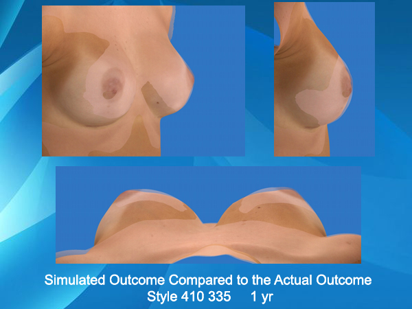 Vectra 3D Imaging comparison