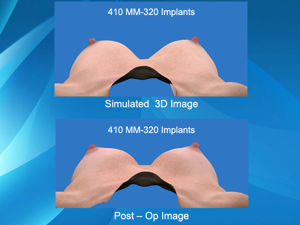 Vectra 3D Imaging comparison