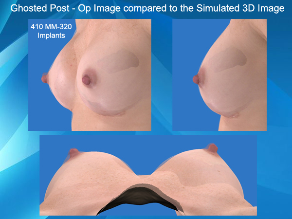 Vectra 3D Imaging comparison