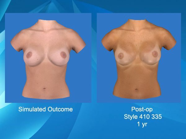 Vectra 3D Imaging comparison