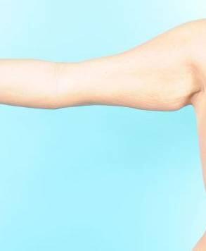 Arm Lift Before & After Image Patient 20000