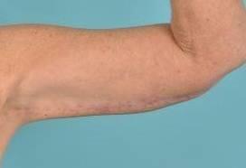 Arm Lift Before & After Image Patient 20002