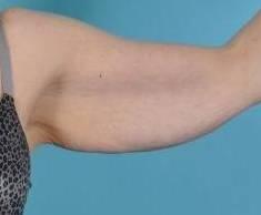 Arm Lift Before & After Image