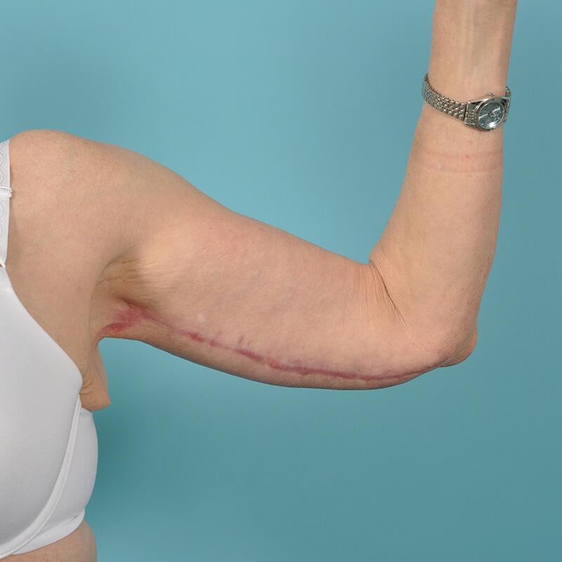 Arm Lift Before & After Image Patient 20007