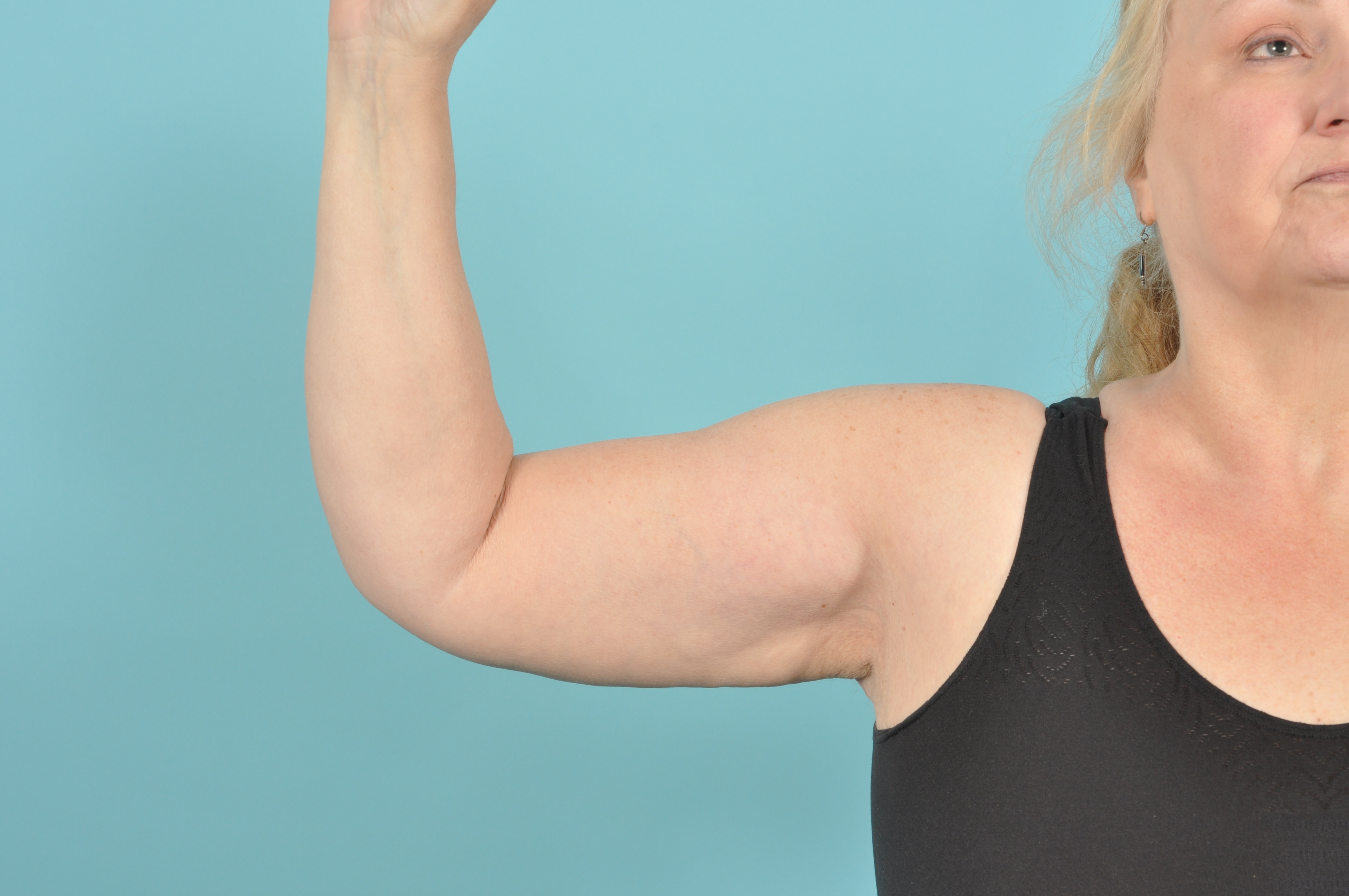 Arm Lift Before & After Image