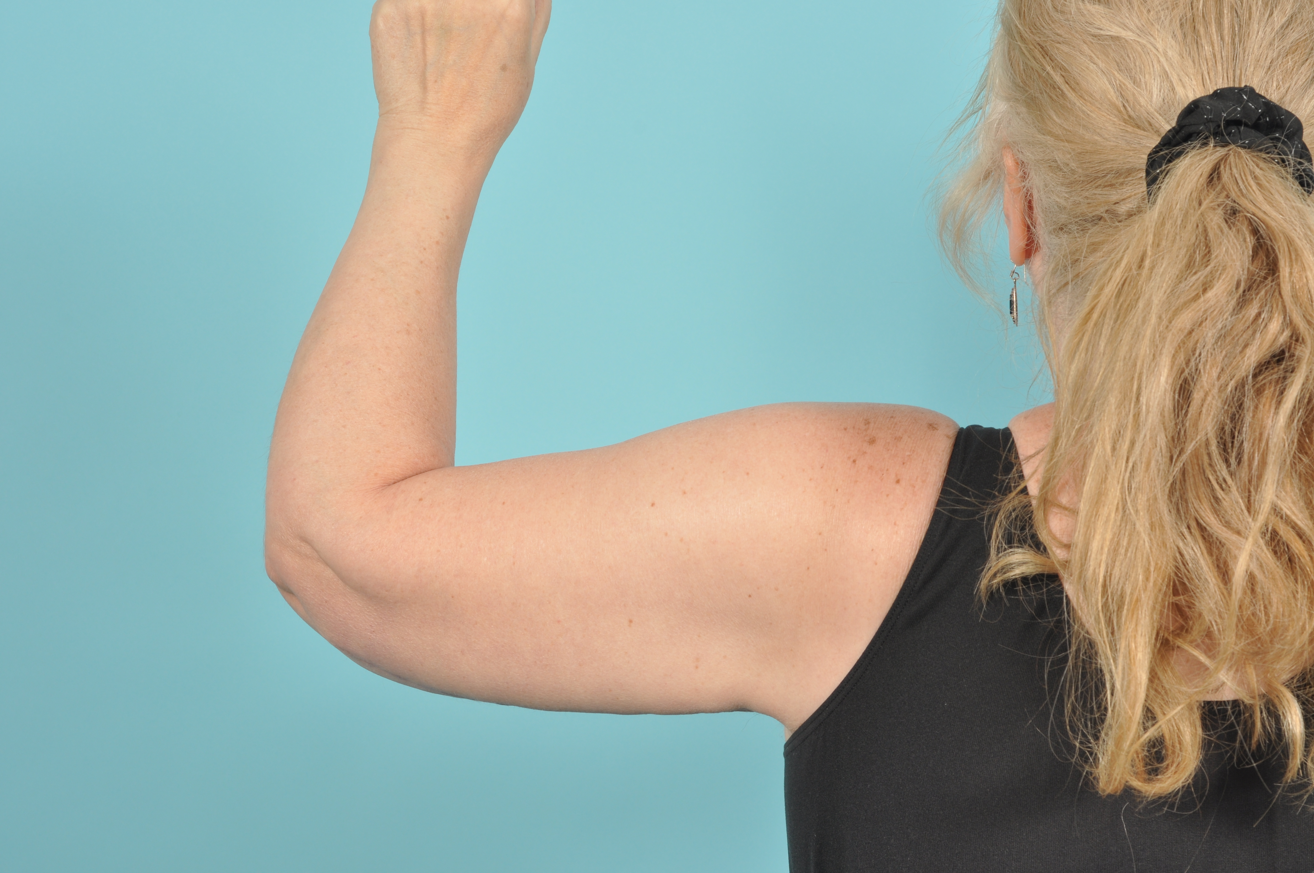 Arm Lift Before & After Image