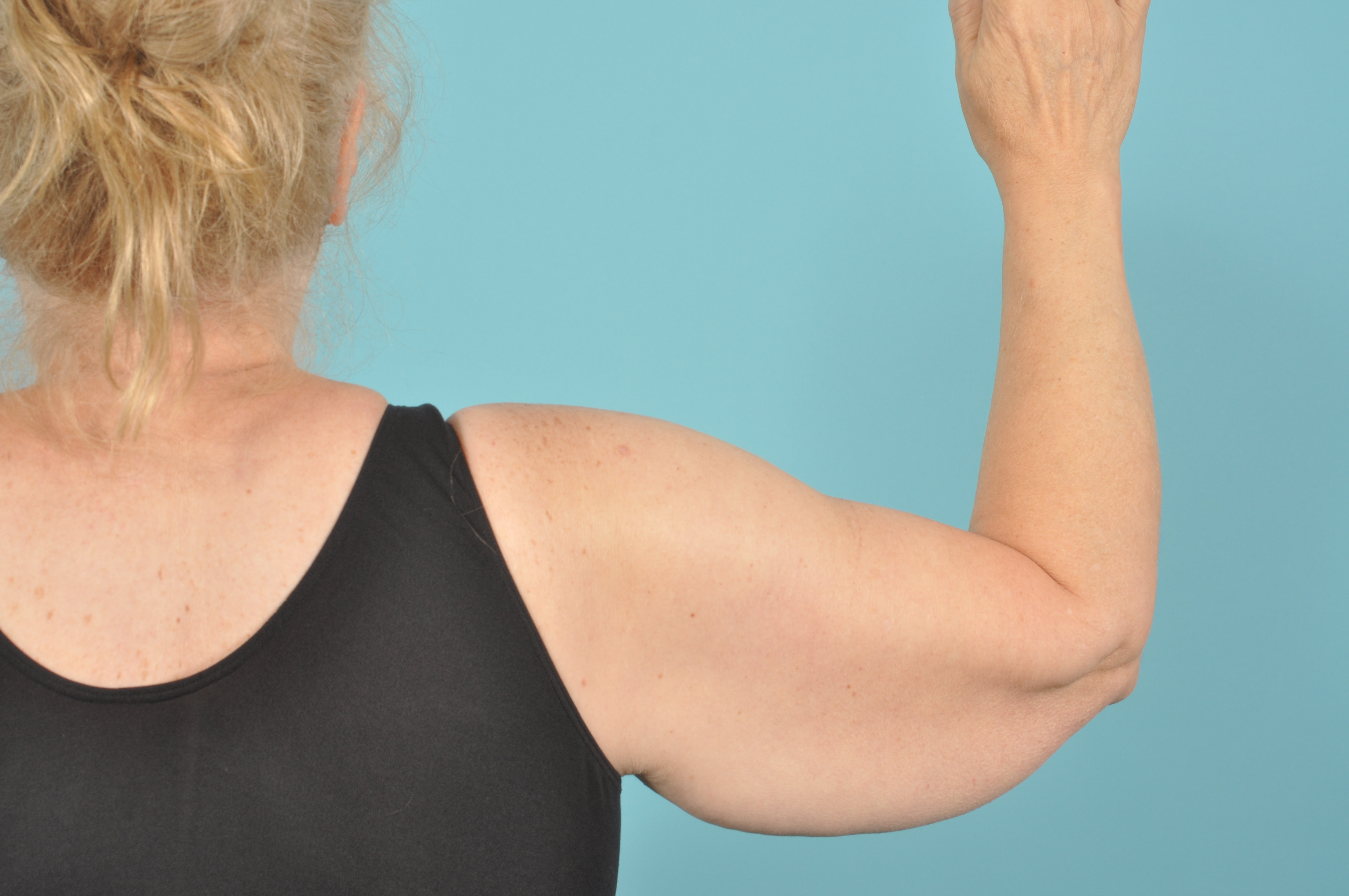 Arm Lift Before & After Image