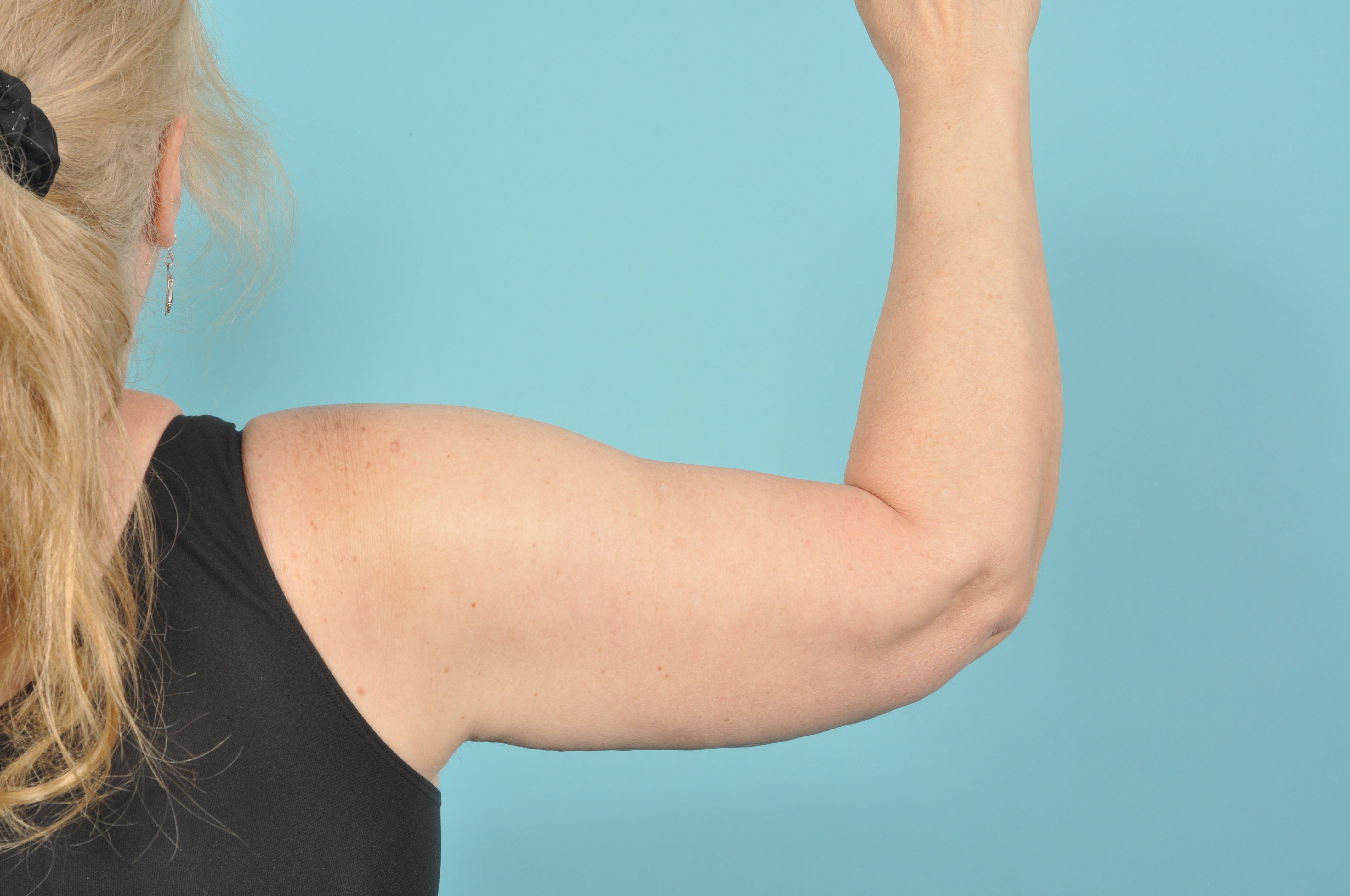 Arm Lift Before & After Image