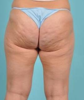 Cellulite Removal Before & After Image