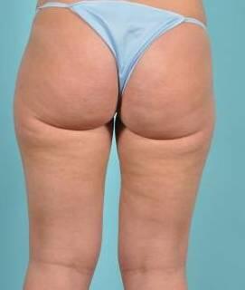 Cellulite Removal Before & After Image Patient 22000