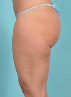 Cellulite Removal Before & After Image