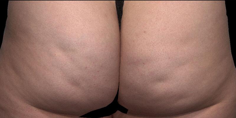 Cellulite Removal Before & After Image Patient 22001