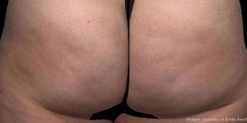 Cellulite Removal Before & After Image Patient 22001