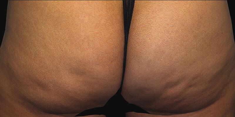 Cellulite Removal Before & After Image