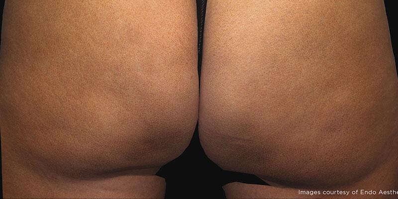 Cellulite Removal Before & After Image Patient 22002