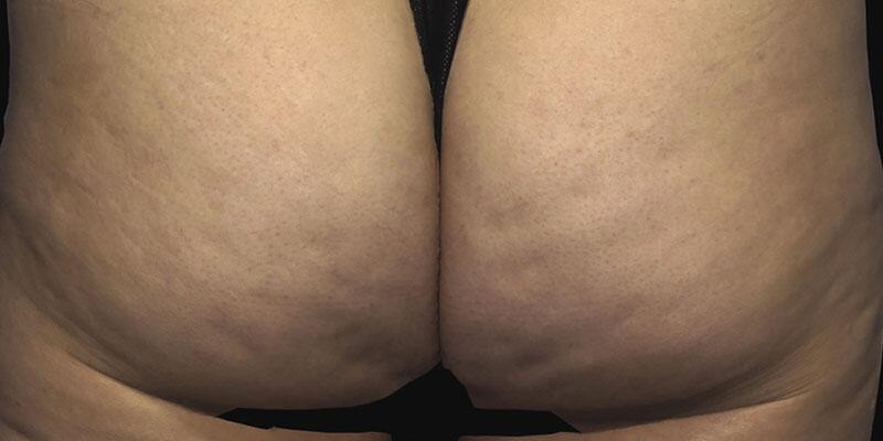 Cellulite Removal Before & After Image