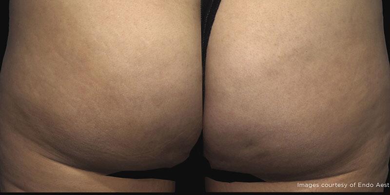 Cellulite Removal Before & After Image