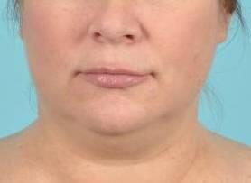 CoolSculpting Before & After Image