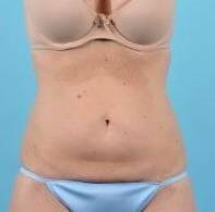 CoolSculpting Before & After Image