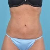 CoolSculpting Before & After Image Patient 23002